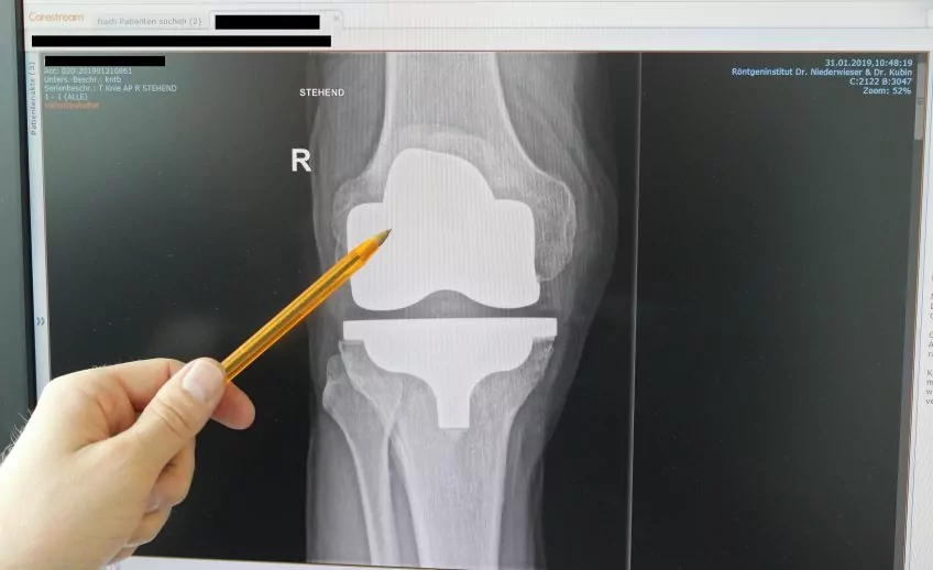 Röntgenbild einer Knieprothese.