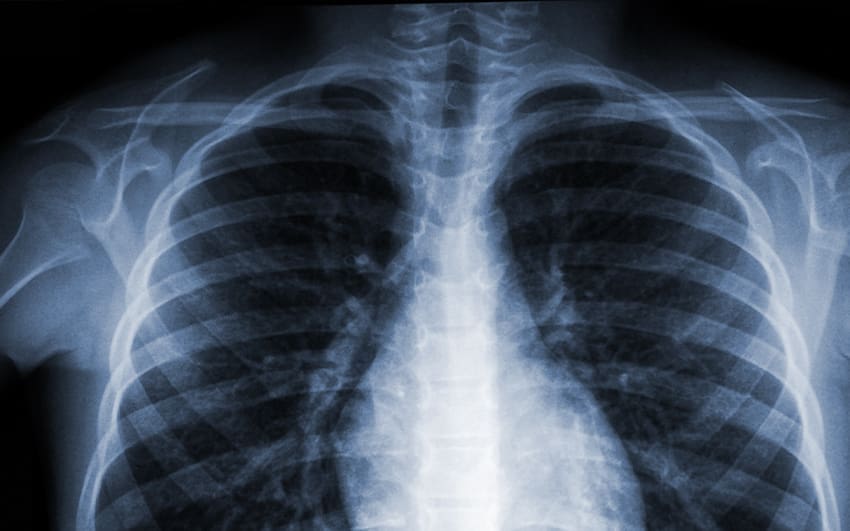 Bild eines Bruströntgen