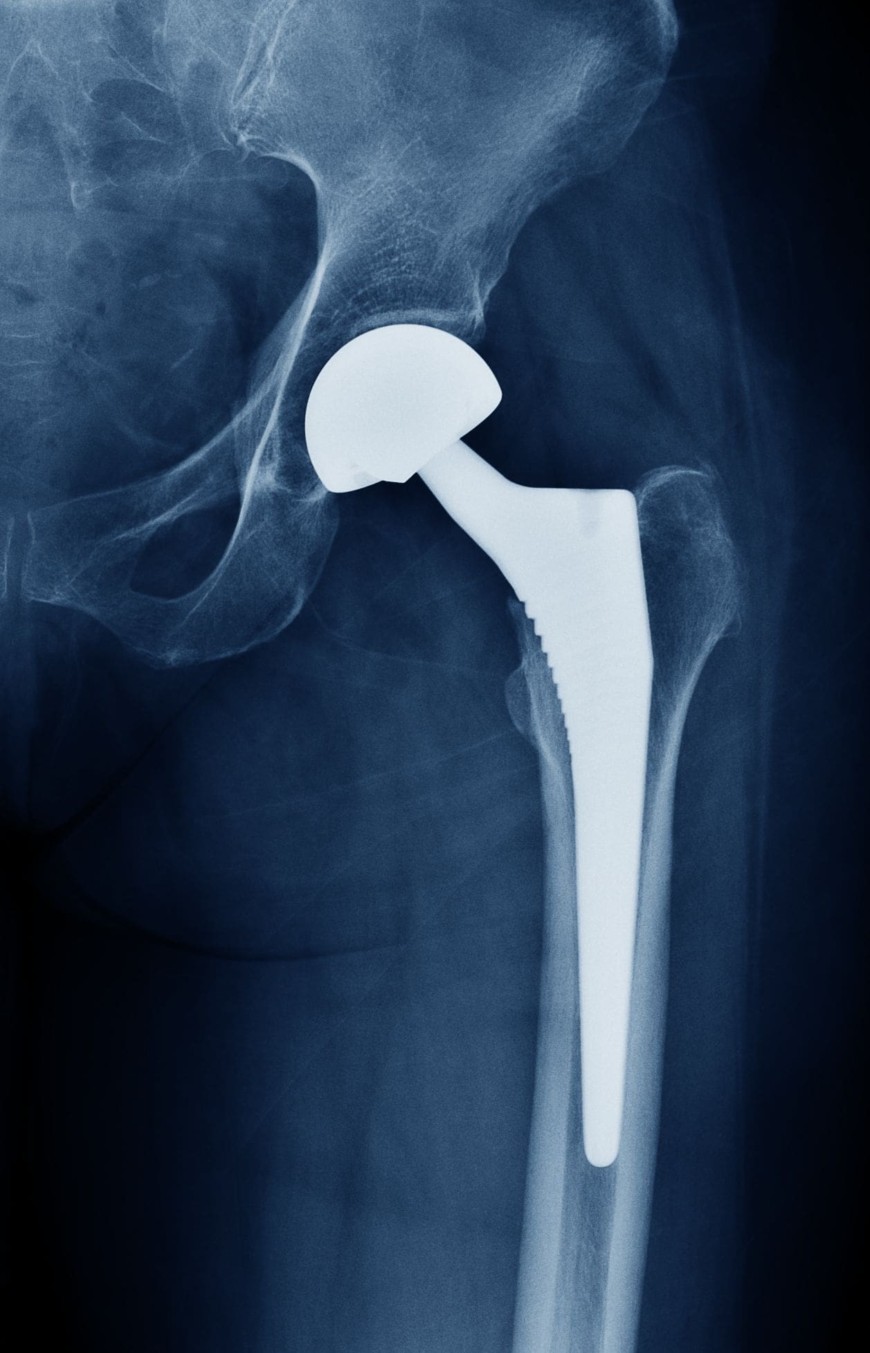 Eine Hüftprothese am Röntgenbild.
